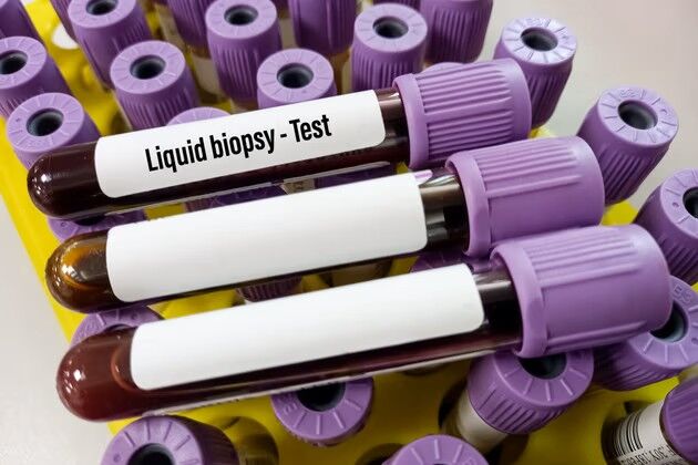 Likit Biyopsi Nedir Likit Biyopsi Nasil Yapilir 9477569