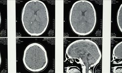 Araştırmalara göre, uykunun REM evresine geçişte zorlanmak Alzheimer belirtisi olabilir