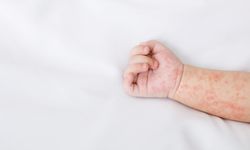 Çocuklarda alerji alarmı