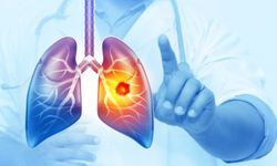 Her yıl 25 bin Akciğer kanseri önlenebilir