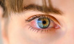 Gözde yanma, sulanma ve kaşıntı varsa demodex parazitine dikkat