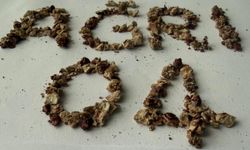 Daha önce 21 kez böbrek taşı operasyonu geçiren hastadan 295 taş çıkarıldı