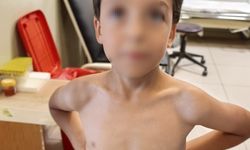 7 yaşındaki Mustafa'nın göğsüne kene yapıştı