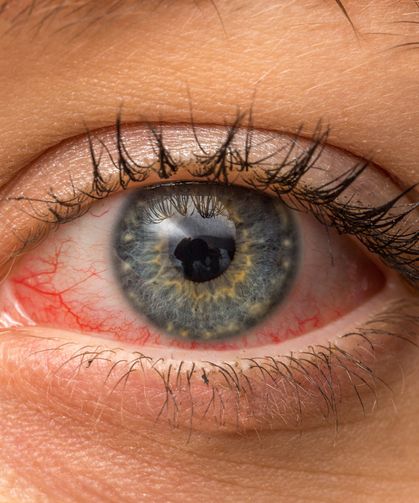 Oruç ve ekran kullanımı göz kuruluğunu tetikliyor