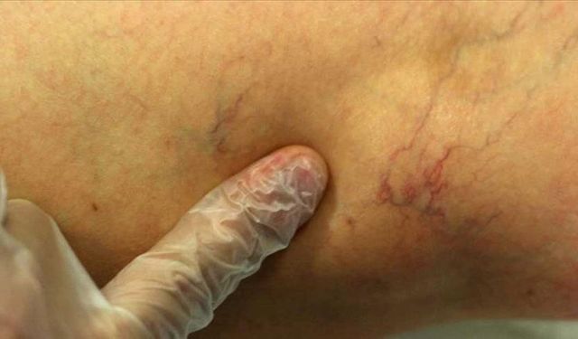 Varis tedavisinde yenilikçi lazer yöntemiyle hasta kısa sürede ayağa kalkıyor