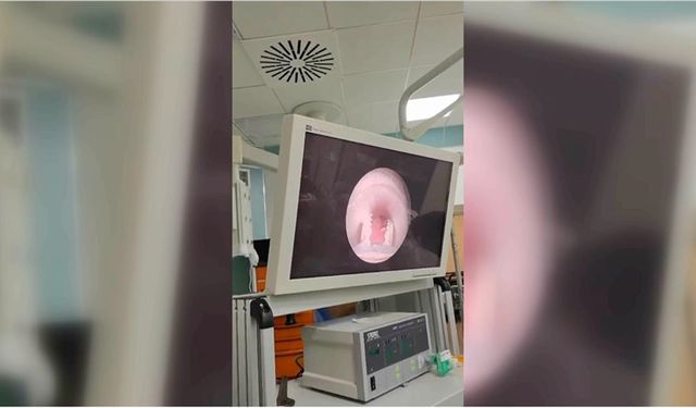 Yutkunamama şikayetiyle hastaneye götürülen çocuğun yemek borusundan et parçası çıktı