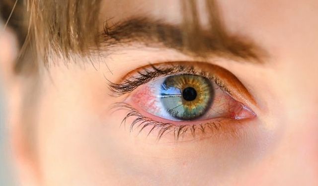 Gözde yanma, sulanma ve kaşıntı varsa demodex parazitine dikkat