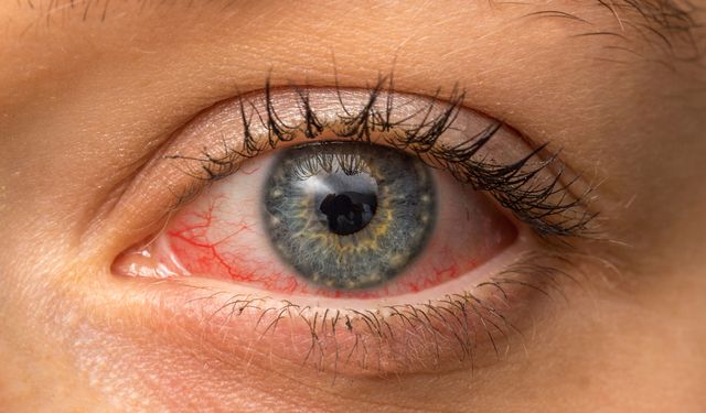 Oruç ve ekran kullanımı göz kuruluğunu tetikliyor