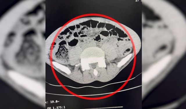 Midesinden uyuşturucu çıkan şüpheli, tutuklandı