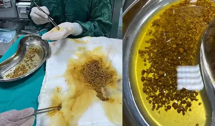 Karın ağrısı şikayetiyle gittiği hastanede safra kesesinden 2 bin 67 taş çıkarıldı